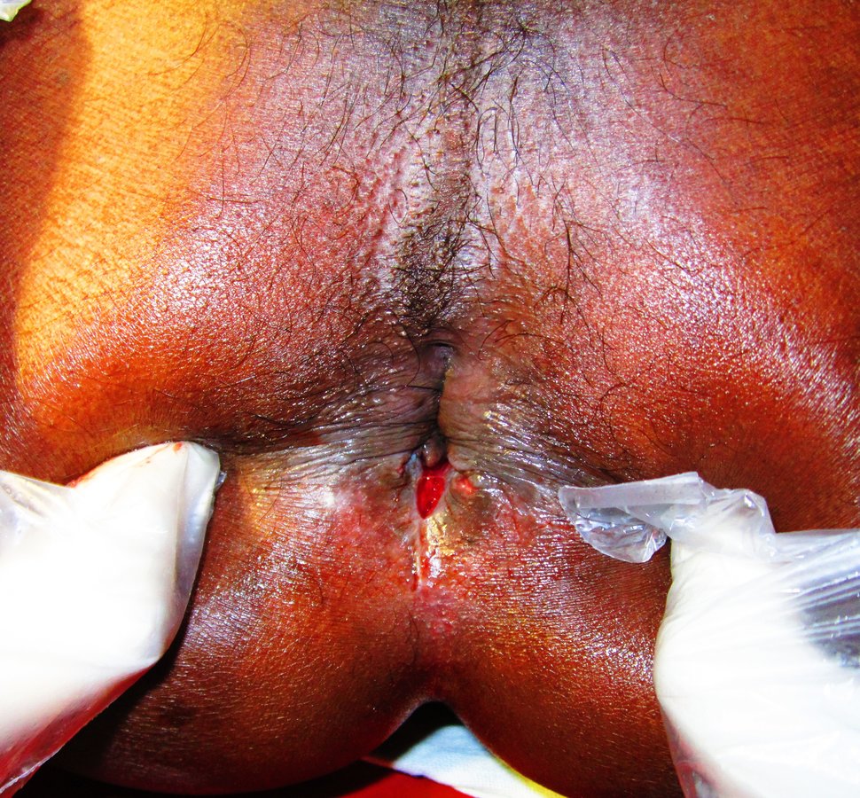 Bhopal Ayurvedic Surgical Center And Wound Clinic - Bhopal Ayurvedic Surgical Center And Wound Clinic