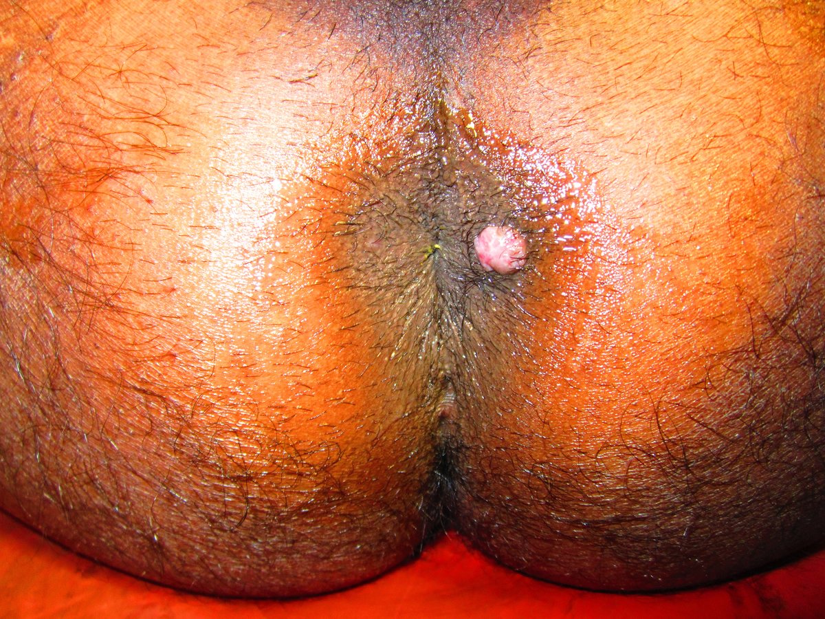 Bhopal Ayurvedic Surgical Center And Wound Clinic - Bhopal Ayurvedic Surgical Center And Wound Clinic