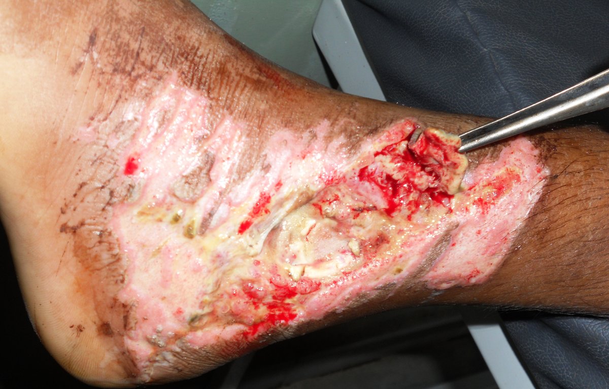 Bhopal Ayurvedic Surgical Center And Wound Clinic - Bhopal Ayurvedic Surgical Center And Wound Clinic