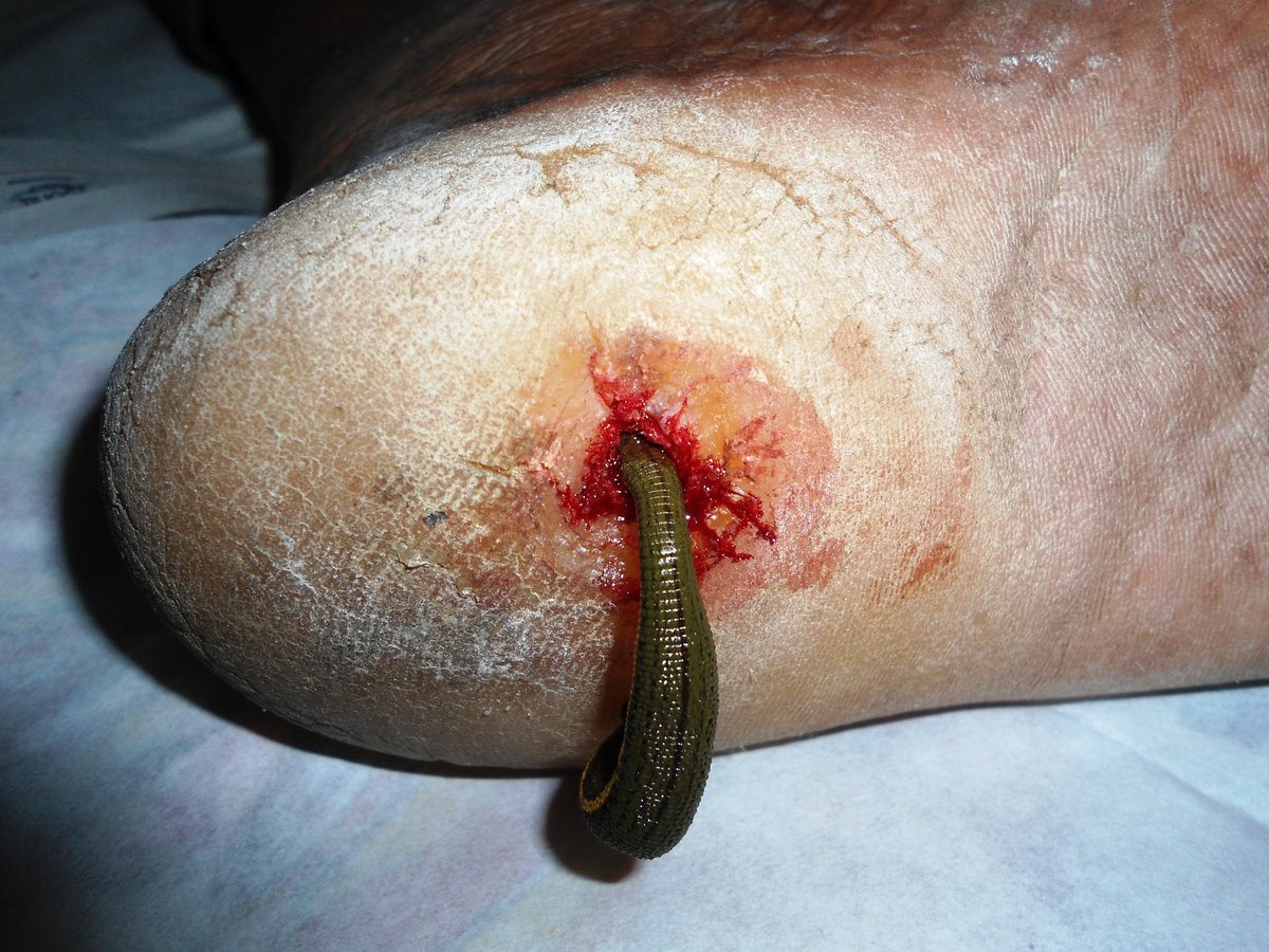 Bhopal Ayurvedic Surgical Center And Wound Clinic - Bhopal Ayurvedic Surgical Center And Wound Clinic