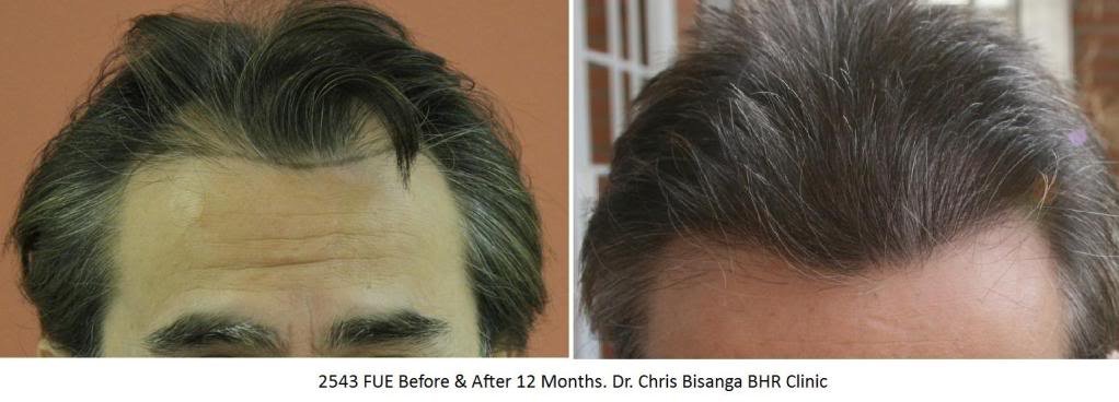 Bisanga Hair Restoration - Bisanga Hair Restoration