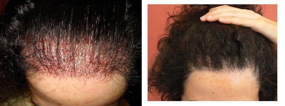 Bisanga Hair Restoration - Bisanga Hair Restoration