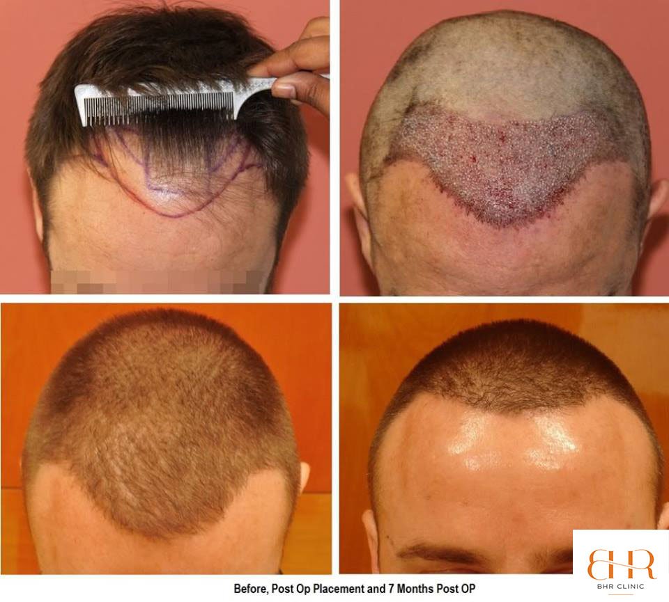 Bisanga Hair Restoration - Bisanga Hair Restoration