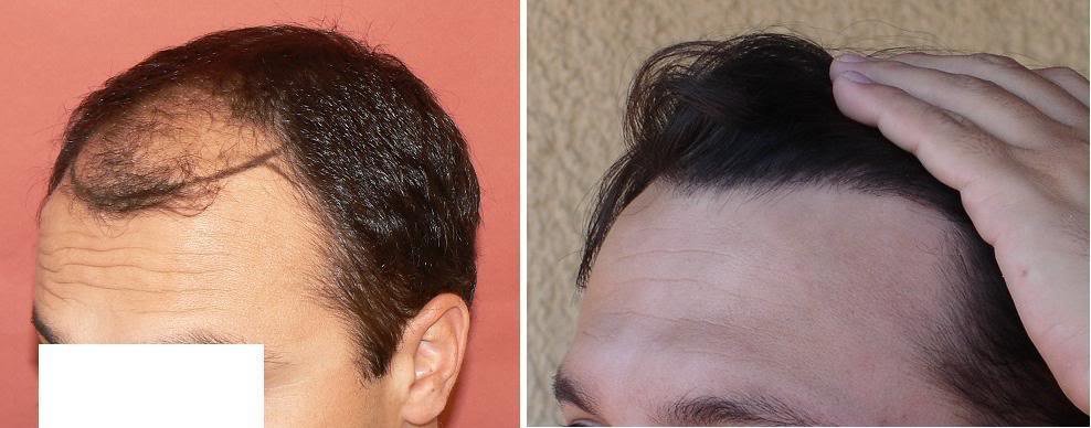 Bisanga Hair Restoration - Bisanga Hair Restoration