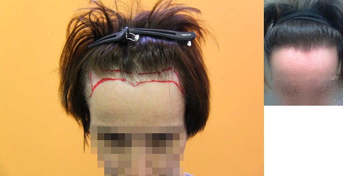 Bisanga Hair Restoration - Bisanga Hair Restoration