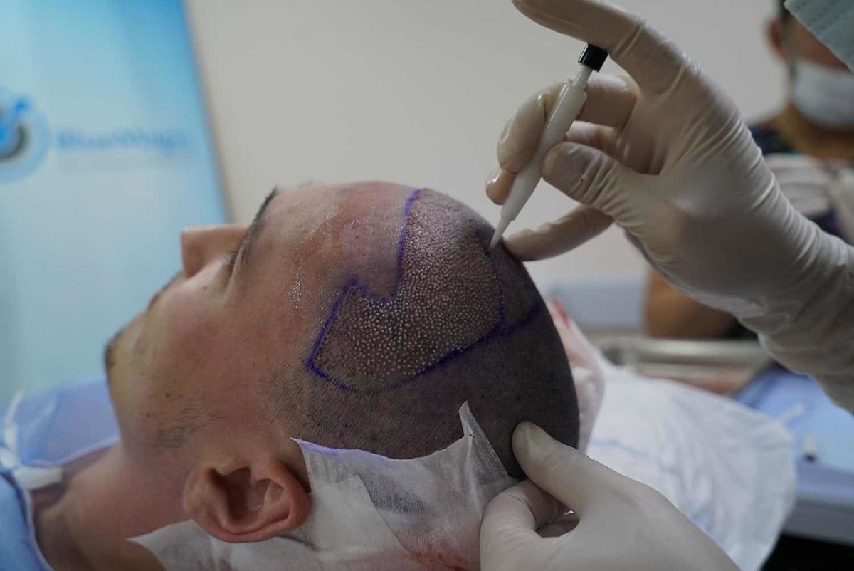 Blue Magic Group - Hair Transplant Professionals - Blue Magic Group - Hair Transplant Professionals