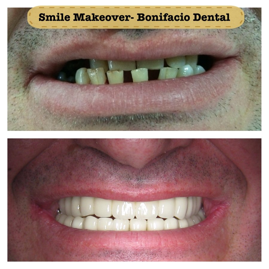 Bonifacio Dental Angeles City Dentist Pampanga PHP - Bonifacio Dental Angeles City Dentist Pampanga PHP