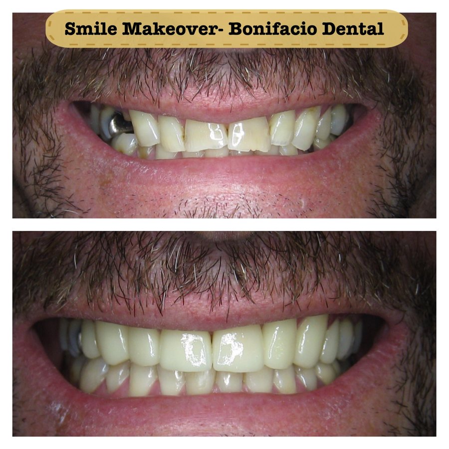 Bonifacio Dental Angeles City Dentist Pampanga PHP - Bonifacio Dental Angeles City Dentist Pampanga PHP