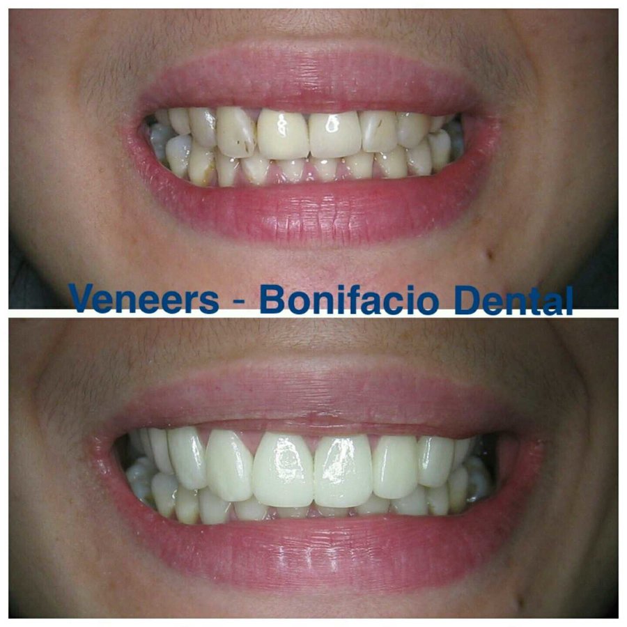 Bonifacio Dental Angeles City Dentist Pampanga PHP - Bonifacio Dental Angeles City Dentist Pampanga PHP