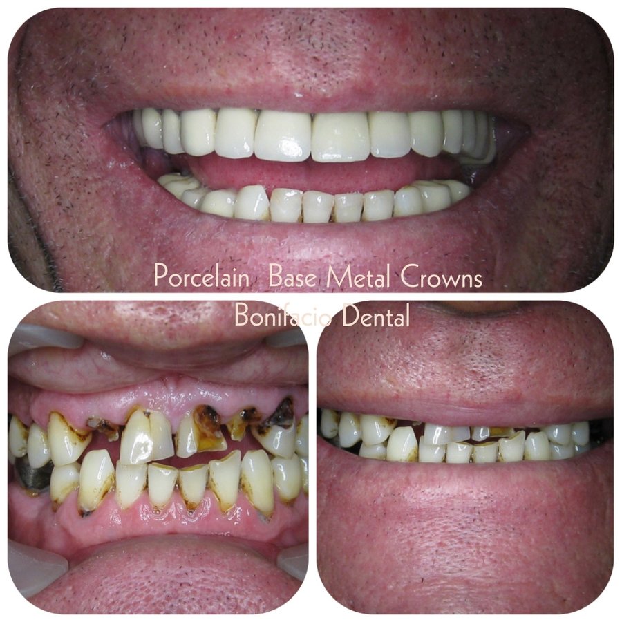 Bonifacio Dental Angeles City Dentist Pampanga PHP - Bonifacio Dental Angeles City Dentist Pampanga PHP