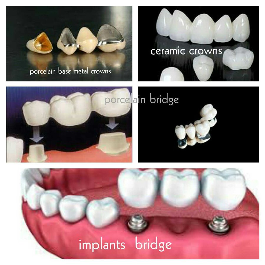 Bonifacio Dental Angeles City Dentist Pampanga PHP - Bonifacio Dental Angeles City Dentist Pampanga PHP