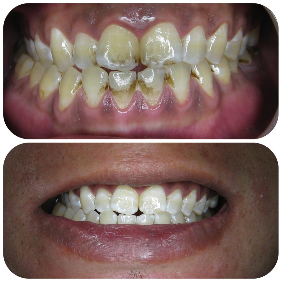 Bonifacio Dental Angeles City Dentist Pampanga PHP - Bonifacio Dental Angeles City Dentist Pampanga PHP