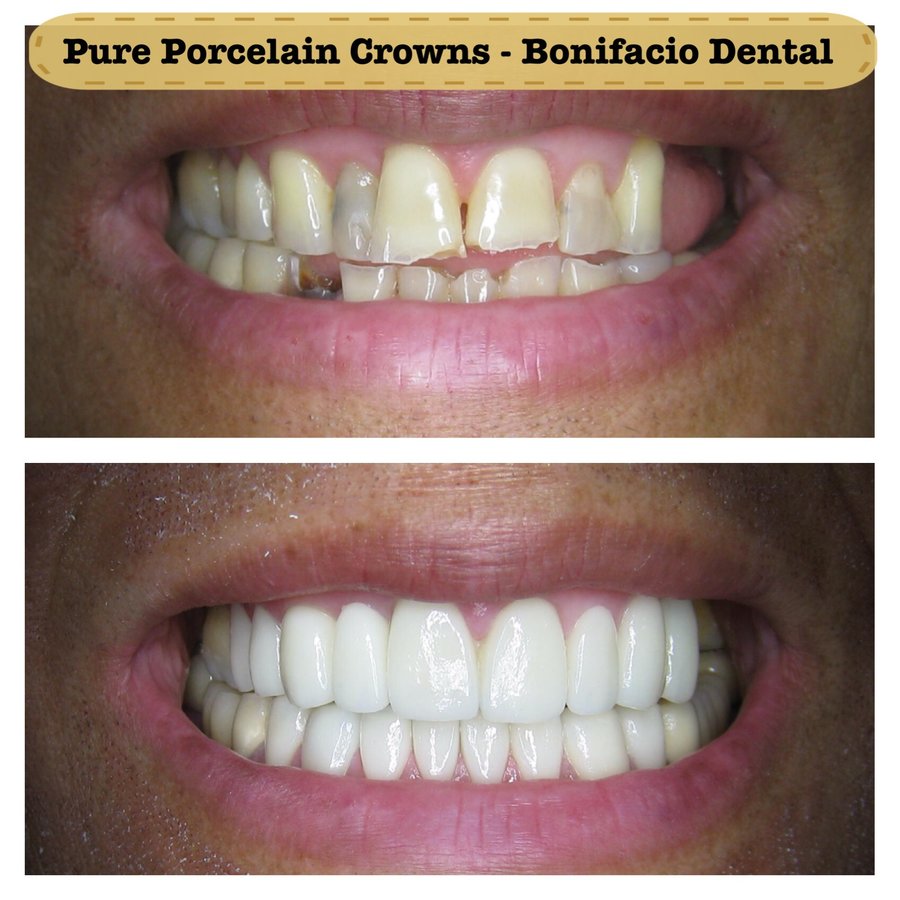 Bonifacio Dental Angeles City Dentist Pampanga PHP - Bonifacio Dental Angeles City Dentist Pampanga PHP