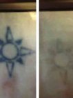 عيادة بريستول لإزالة الوشم - Bristol Tattoo Removal Clinic