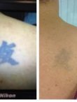 عيادة بريستول لإزالة الوشم - Bristol Tattoo Removal Clinic
