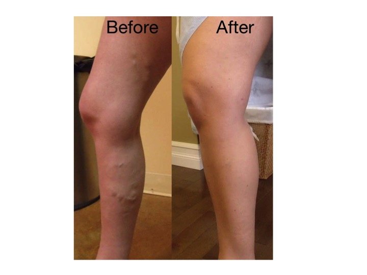 Canada Vein Clinics - Halifax - Canada Vein Clinics - Halifax