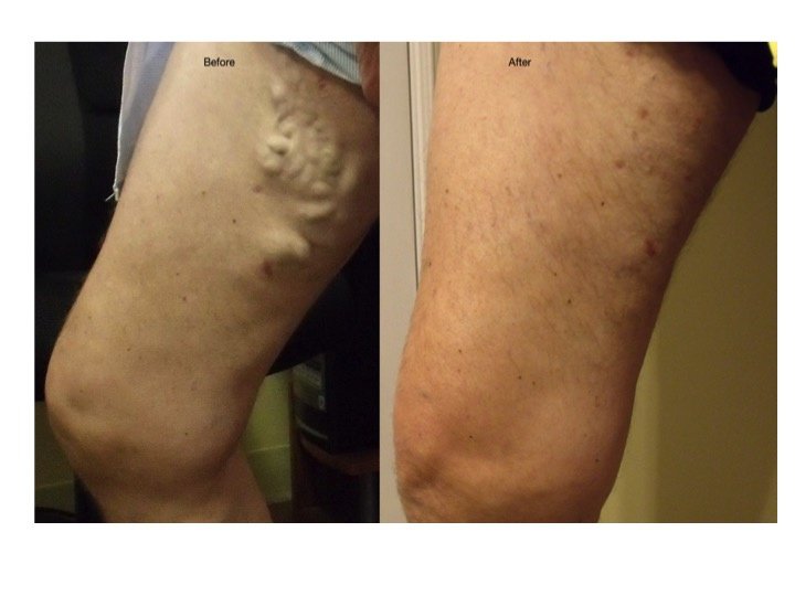 Canada Vein Clinics - Halifax - Canada Vein Clinics - Halifax