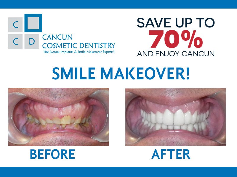 Cancun Cosmetic Dentistry - Cancun Cosmetic Dentistry