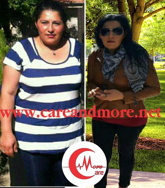 Care And More - Obesity Solutions - Edirne . - Care And More - Obesity Solutions - Edirne .