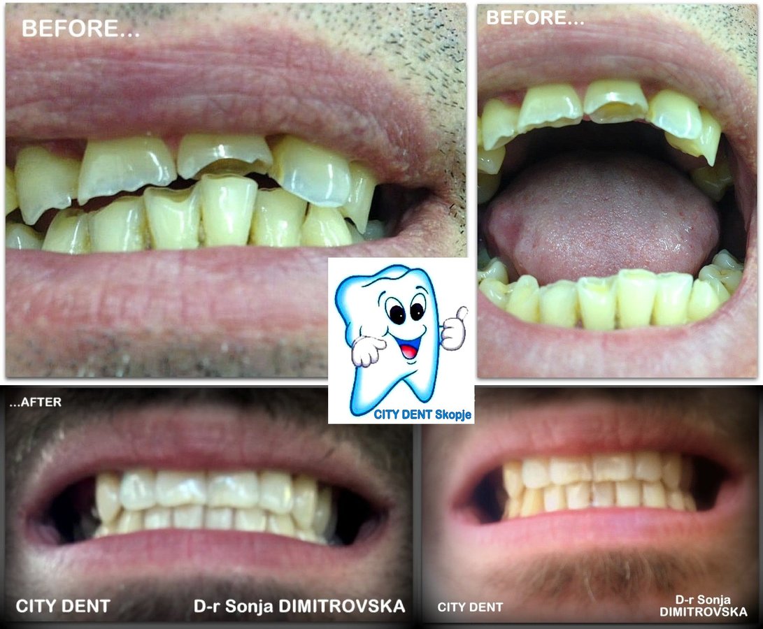 City Dent - City Dent