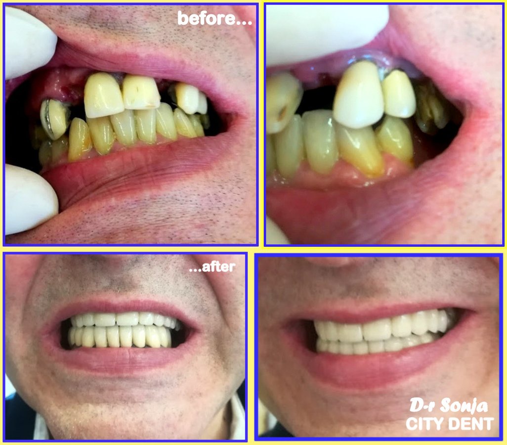 City Dent - City Dent