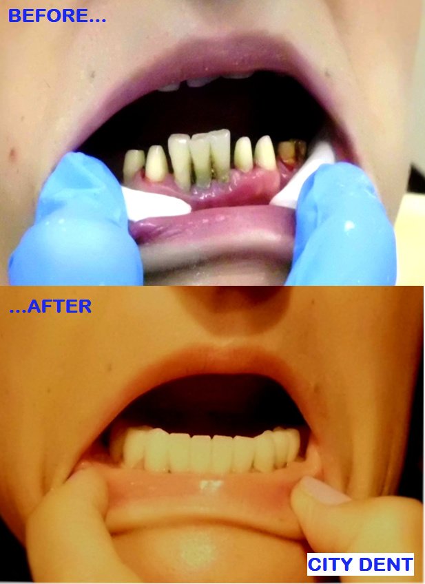 City Dent - City Dent