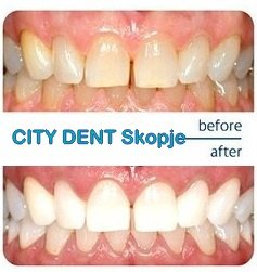 City Dent - City Dent