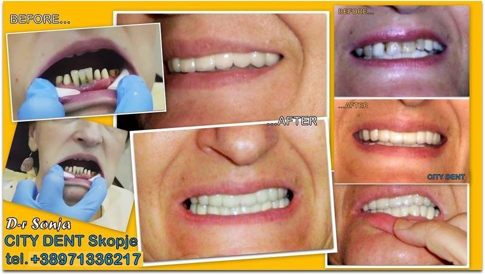 City Dent - City Dent