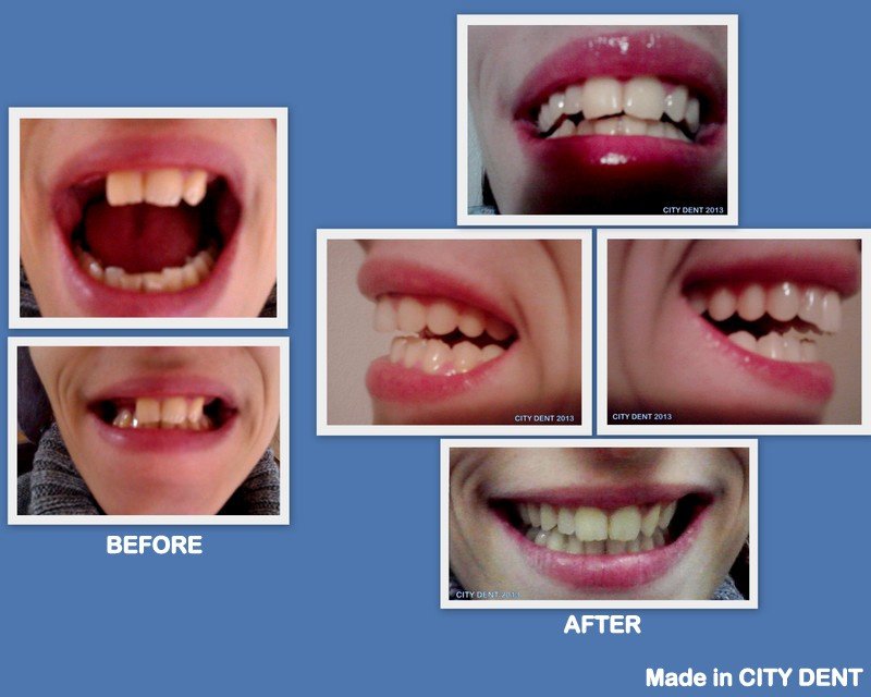 City Dent - City Dent