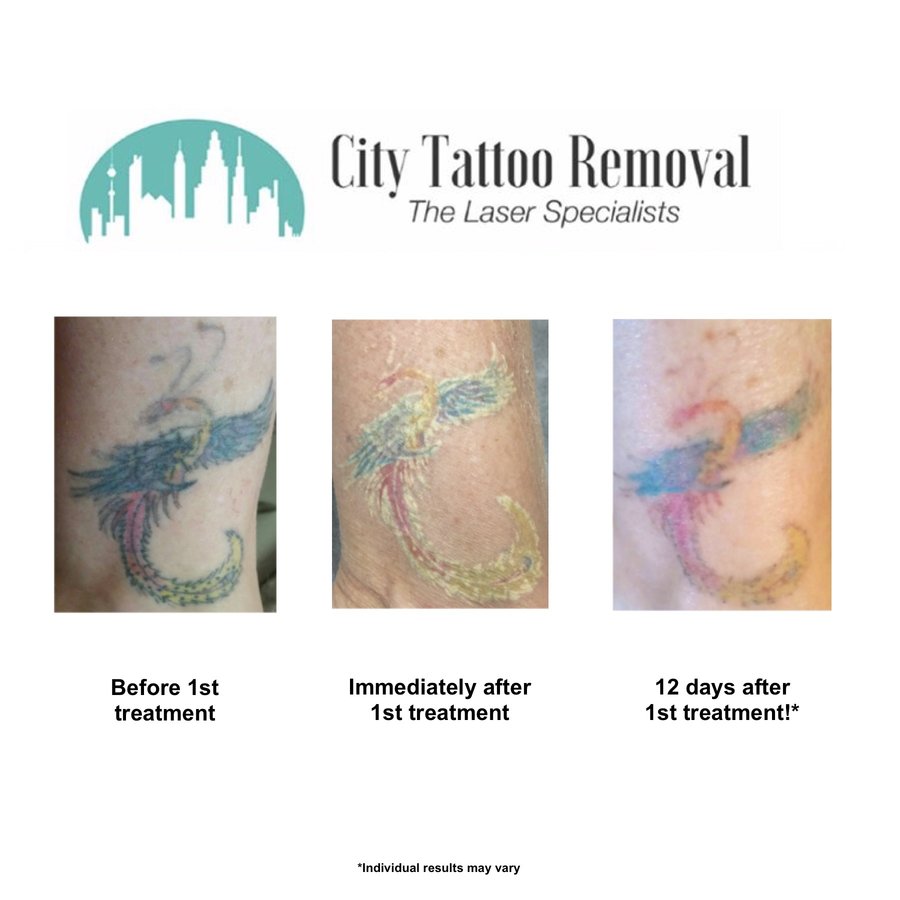 City Tattoo Removal - City Tattoo Removal
