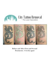 City Tattoo Removal - City Tattoo Removal