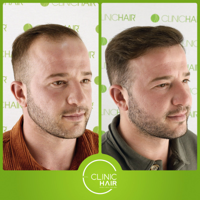 CLINIC HAIR  - Bef Aft