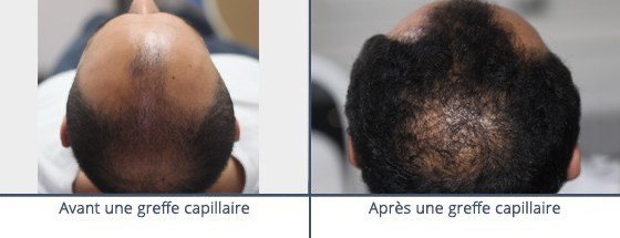 عيادة زراعة الشعر في باريس - Clinic of Hair Transplant in Paris
