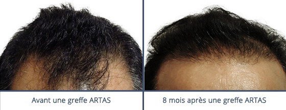عيادة زراعة الشعر في باريس - Clinic of Hair Transplant in Paris