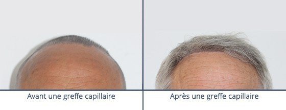 عيادة زراعة الشعر في باريس - Clinic of Hair Transplant in Paris