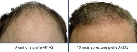 عيادة زراعة الشعر في باريس - Clinic of Hair Transplant in Paris