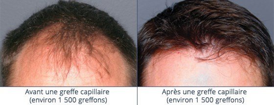 عيادة زراعة الشعر في باريس - Clinic of Hair Transplant in Paris