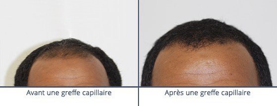 عيادة زراعة الشعر في باريس - Clinic of Hair Transplant in Paris