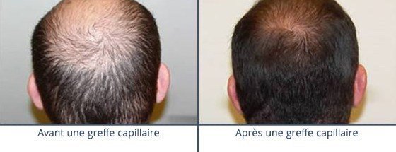 عيادة زراعة الشعر في باريس - Clinic of Hair Transplant in Paris