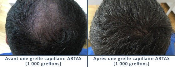 عيادة زراعة الشعر في باريس - Clinic of Hair Transplant in Paris