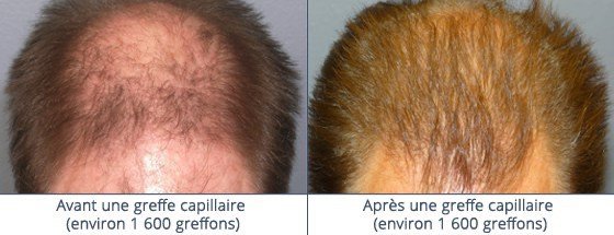 عيادة زراعة الشعر في باريس - Clinic of Hair Transplant in Paris