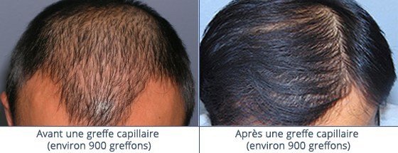 عيادة زراعة الشعر في باريس - Clinic of Hair Transplant in Paris