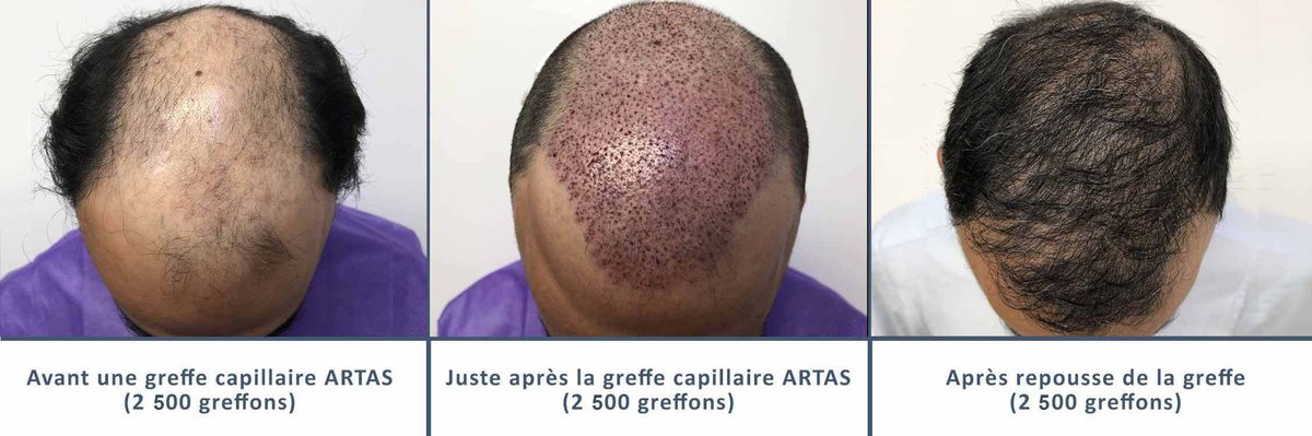عيادة زراعة الشعر في باريس - Clinic of Hair Transplant in Paris