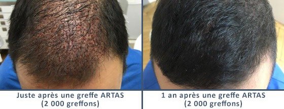 عيادة زراعة الشعر في باريس - Clinic of Hair Transplant in Paris