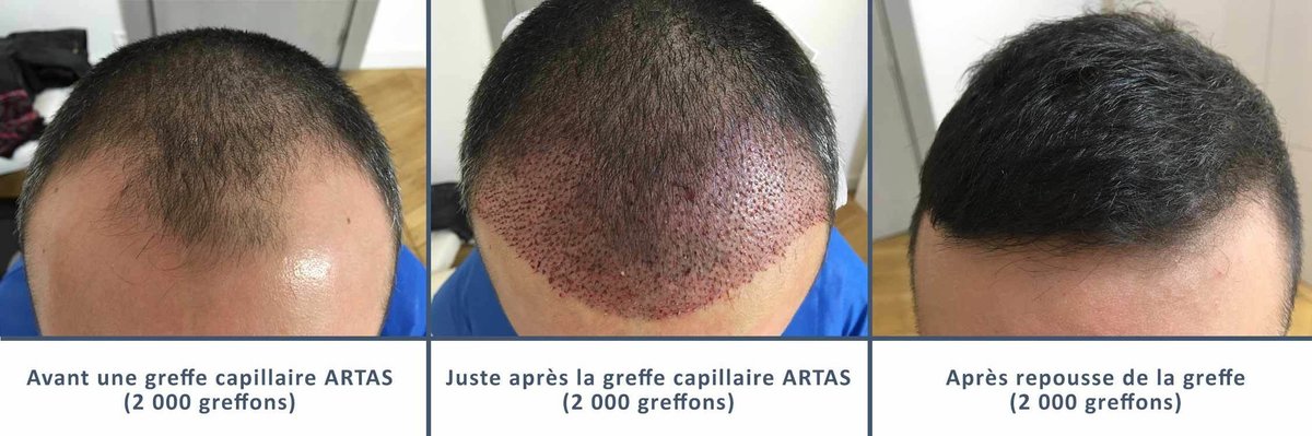 عيادة زراعة الشعر في باريس - Clinic of Hair Transplant in Paris