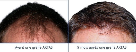 عيادة زراعة الشعر في باريس - Clinic of Hair Transplant in Paris
