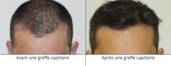 عيادة زراعة الشعر في باريس - Clinic of Hair Transplant in Paris