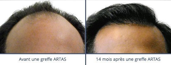 عيادة زراعة الشعر في باريس - Clinic of Hair Transplant in Paris
