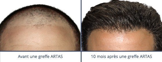 عيادة زراعة الشعر في باريس - Clinic of Hair Transplant in Paris
