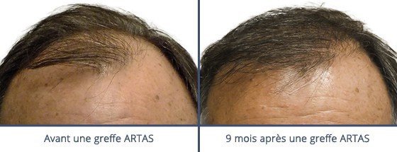 عيادة زراعة الشعر في باريس - Clinic of Hair Transplant in Paris